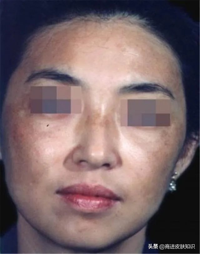 黄褐斑长什么样图片?