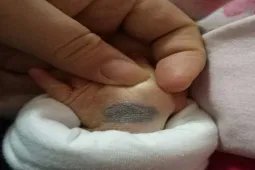 宝宝手背上有青色胎记图片