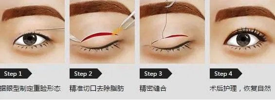 做双眼皮有几种方法?