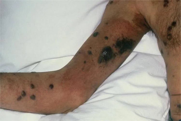 卡波氏肉瘤四肢图片