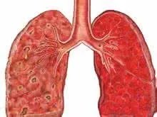 肺癌肝转移症状?