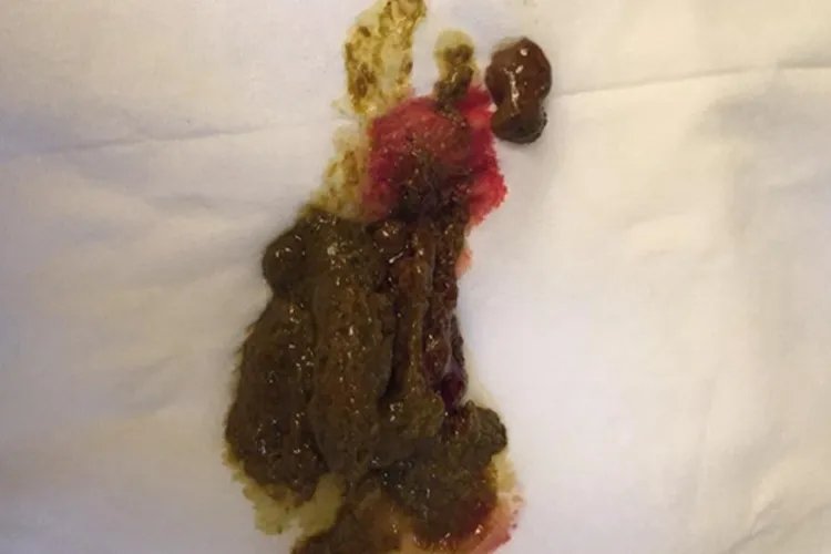 肠癌大便变细图片