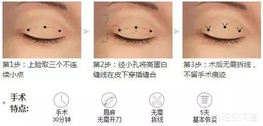 做双眼皮有几种方法?