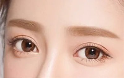 双眼皮全切是什么意思