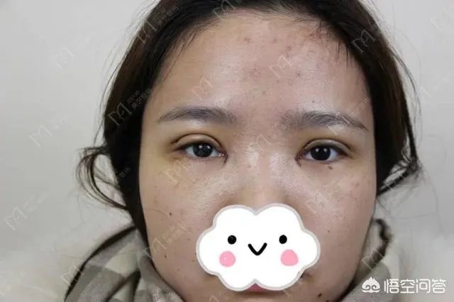 做双眼皮有几种方法?