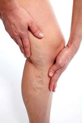 荨麻疹血管炎会有后遗症吗