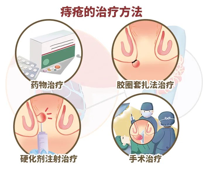 痔疮的治疗方法