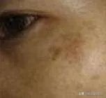 黄褐斑长什么样图片?