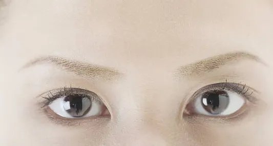 韩式定位双眼皮风险