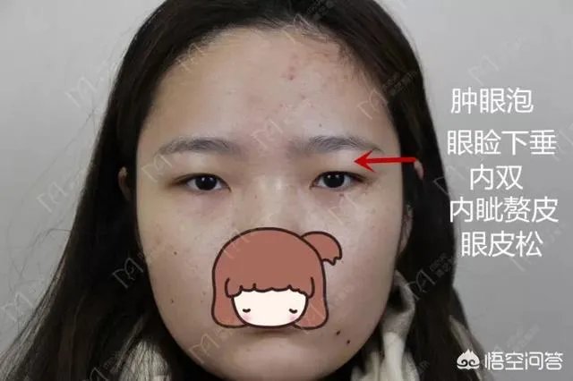 做双眼皮有几种方法?