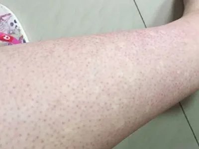 马歇尔-怀特综合征症状图片