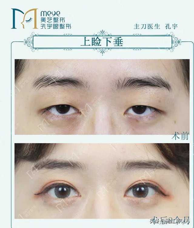 做双眼皮有几种方法?