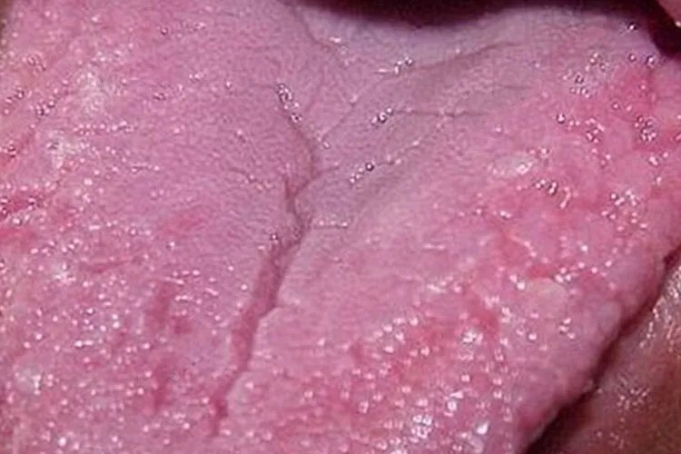 胃癌早期舌头裂纹图片