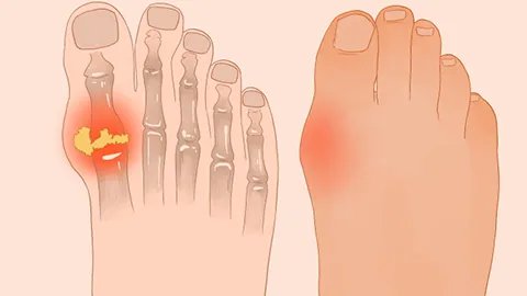 痛风症状的早期表现