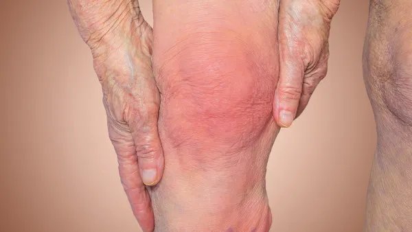 风湿热痹饮食注意事项有哪些 风湿热痹是怎么回事