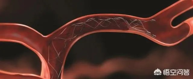 在未来，能做全身的血管支架手术吗？