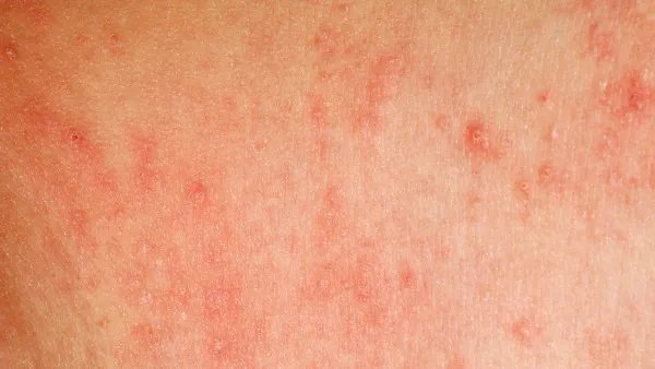 急性荨麻疹会传染吗