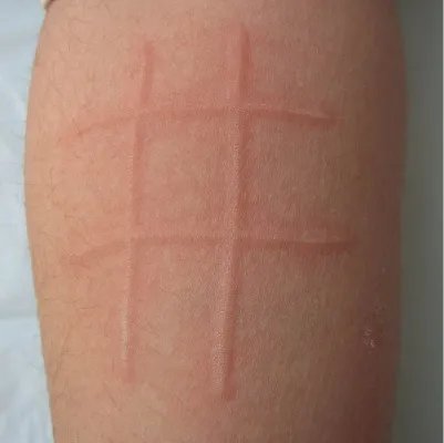 慢性荨麻疹图片和症状