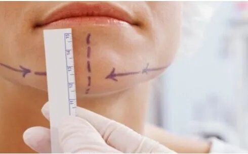 南京光纤溶脂瘦脸手术整形有哪些的医院有哪些?哪家光纤溶脂瘦脸手术整形手术效果好?