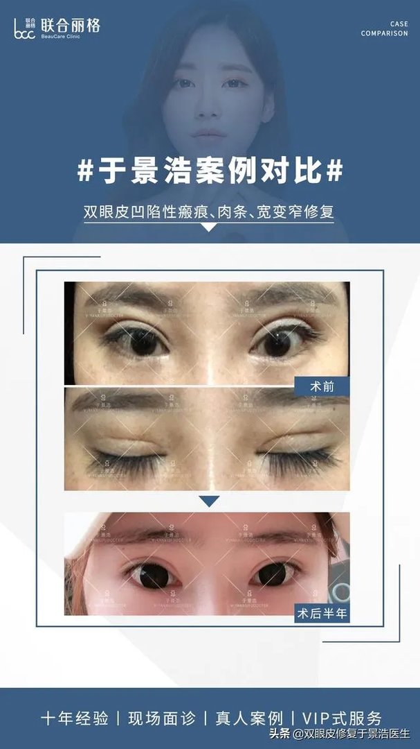 做双眼皮有几种方法?