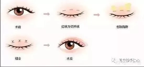 做双眼皮有几种方法?