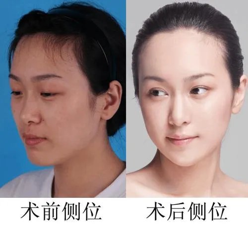 鼻综合手术前后的注意事项有什么呢？