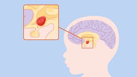 脑动脉破裂是怎么引起的