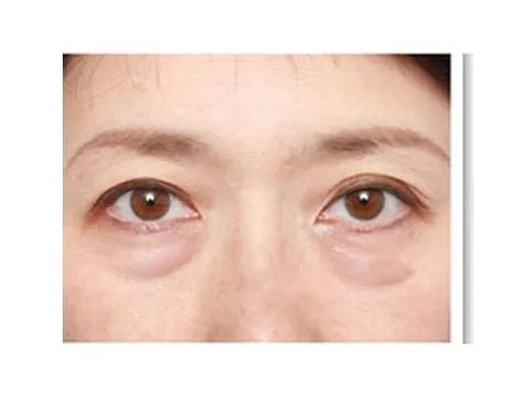 激光去眼袋多少钱