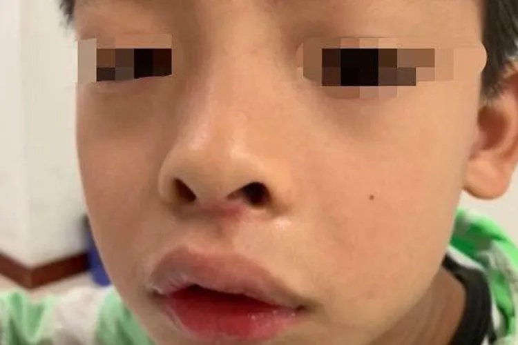 儿童腺样体面容初期图片