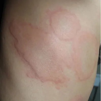 慢性荨麻疹图片和症状
