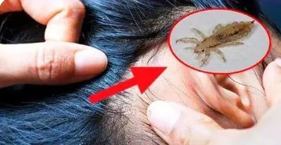 梦见虱子是什么意思