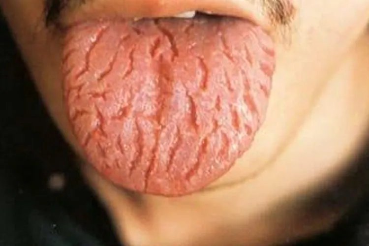 胃癌早期舌头裂纹图片
