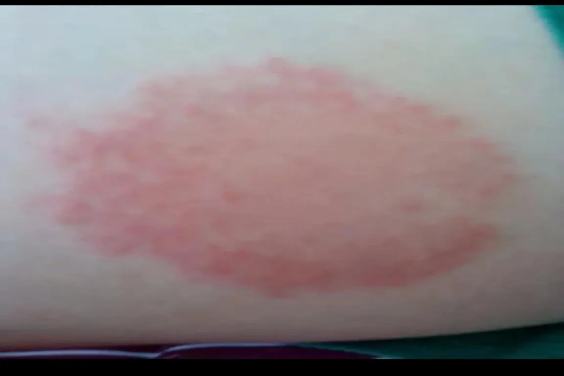 一片红疹子很痒图片