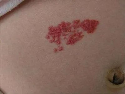 弥漫性躯体性血管角化瘤丘疹图片