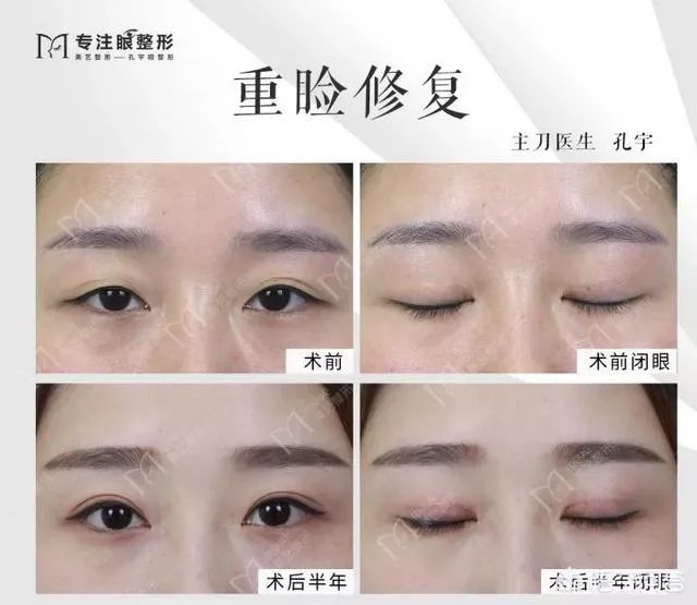 做双眼皮有几种方法?