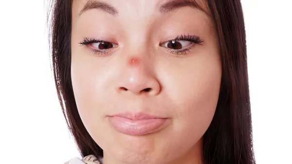 脸上长痘痘怎么办