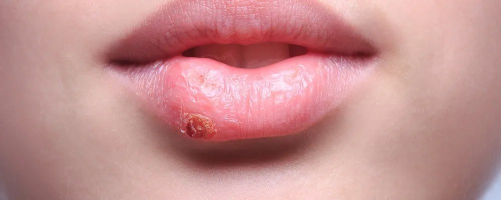 嘴唇长水泡是怎么回事