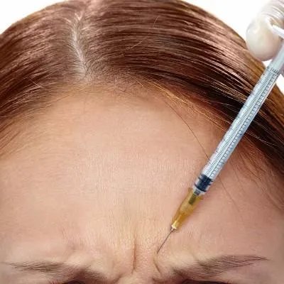 激光点痣多少钱