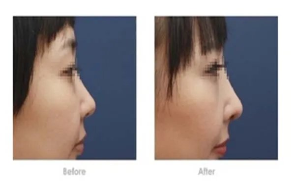 深圳做自体隆鼻有哪些靠前的美容整形医院榜单曝光!看一看不吃亏!