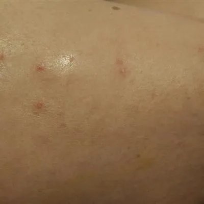 婴儿脸上得湿疹怎么办