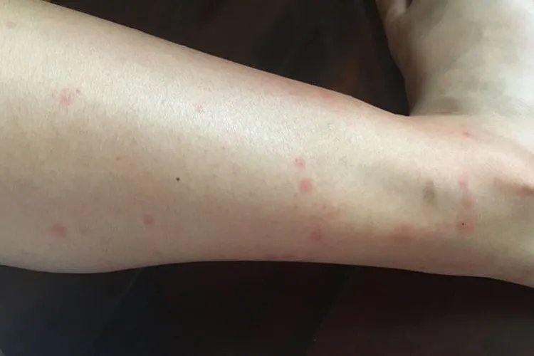 吃蝗虫过敏症状图片