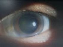 视物模糊，看东西有重影可能是麻痹性斜视