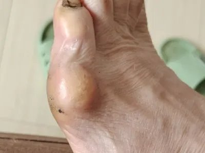 皮肤纤维瘤结节图片