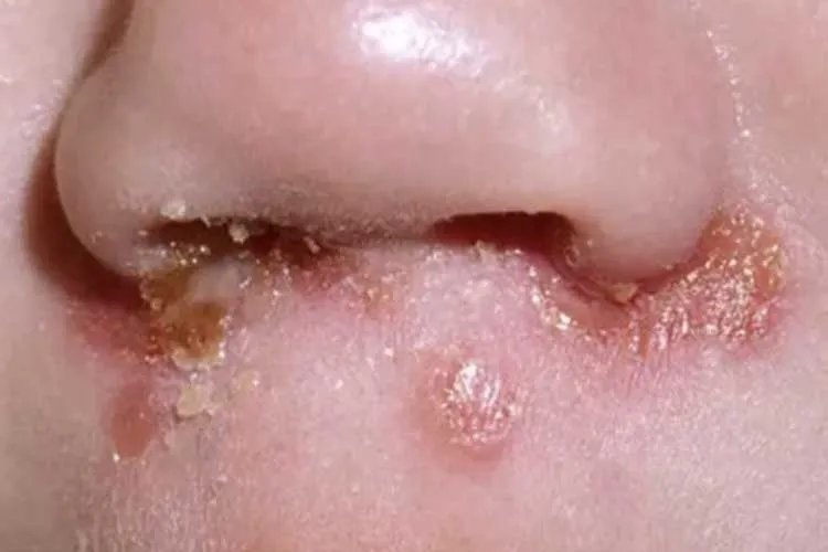 黄皮疮症状的图片