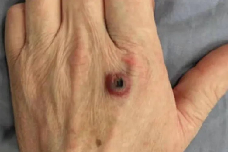 皮肤炭疽红肿图片