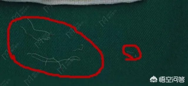 做双眼皮有几种方法?