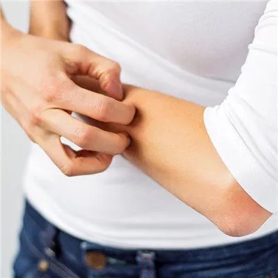 过敏性皮炎症状