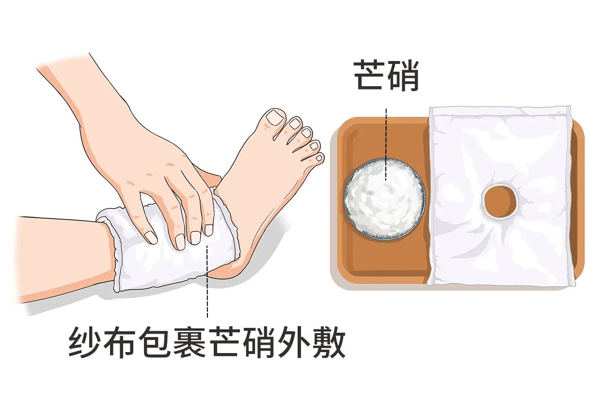 芒硝外敷的用法图片