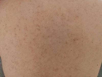 毛发苔藓斑图片