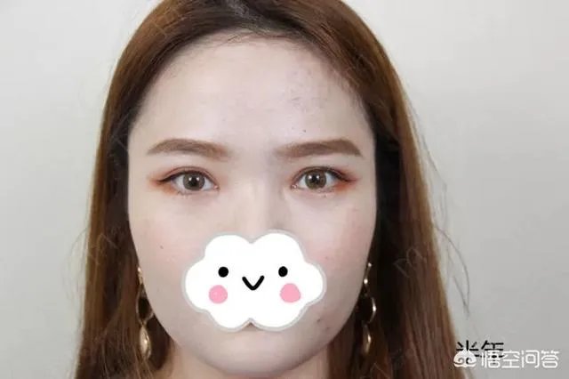 做双眼皮有几种方法?